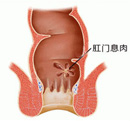 大肠息肉早期症状有哪些？